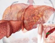 कलेजो सुस्तै बिगार्ने रोग - लिभर सिरोसिस : कारण, लक्षण र रोकथाम